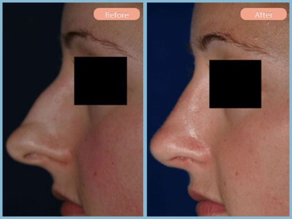Before and After Image: Rhinoplasty - left-side