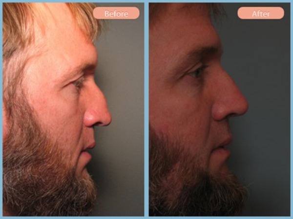 Before and After Image: Rhinoplasty - right-side