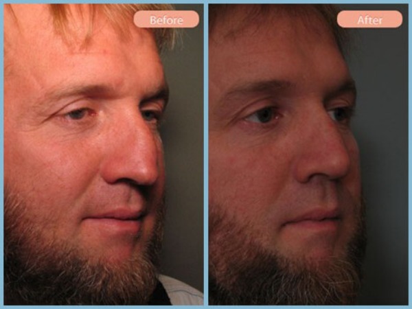 Before and After Image: Rhinoplasty - right-front-oblique