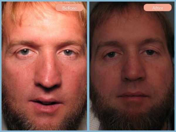 Before and After Image: Rhinoplasty - front