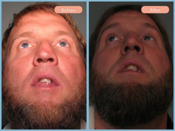 Before and After Image: Rhinoplasty - front