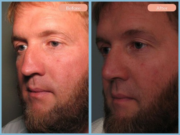 Before and After Image: Rhinoplasty - left-front-oblique