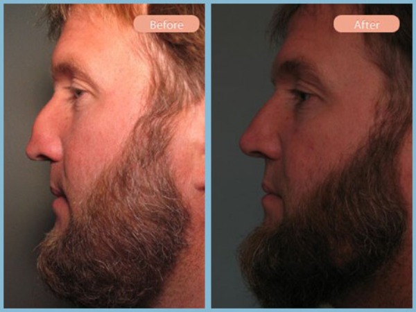 Before and After Image: Rhinoplasty - left-side