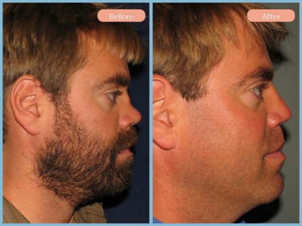Before and After Image: Rhinoplasty - right-side