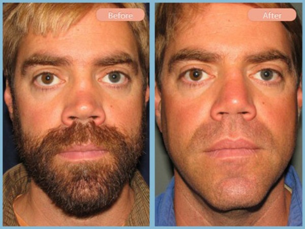 Before and After Image: Rhinoplasty - front