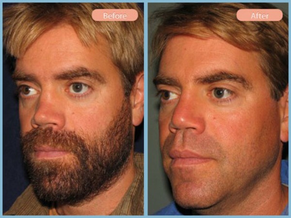 Before and After Image: Rhinoplasty - left-front-oblique