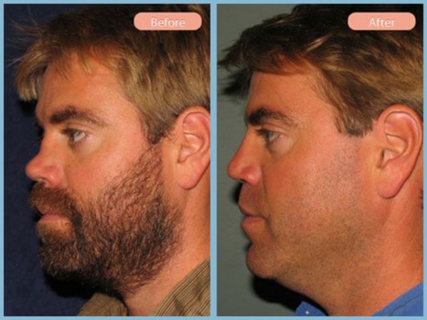 Before and After Image: Rhinoplasty - left-side