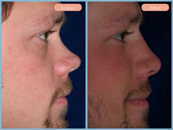 Before and After Image: Rhinoplasty - right-side