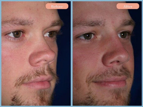 Before and After Image: Rhinoplasty - right-front-oblique