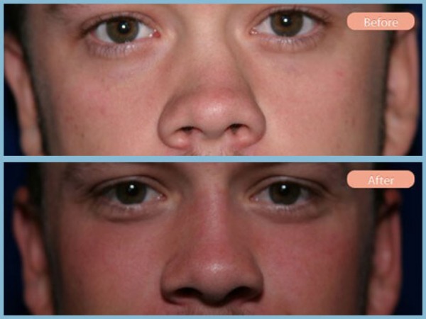 Before and After Image: Rhinoplasty - front