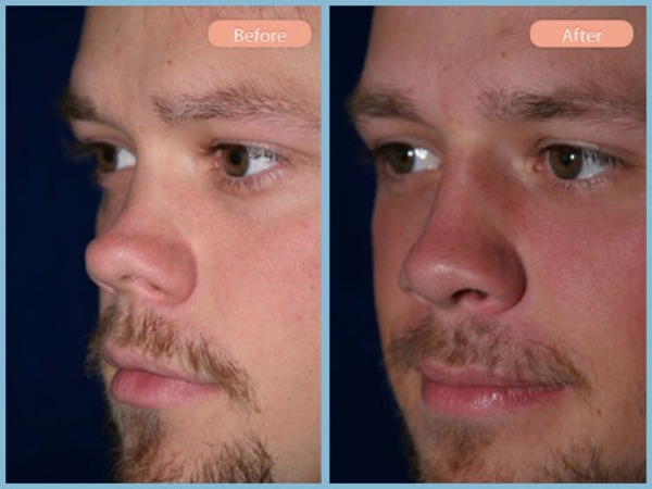 Before and After Image: Rhinoplasty - left-front-oblique