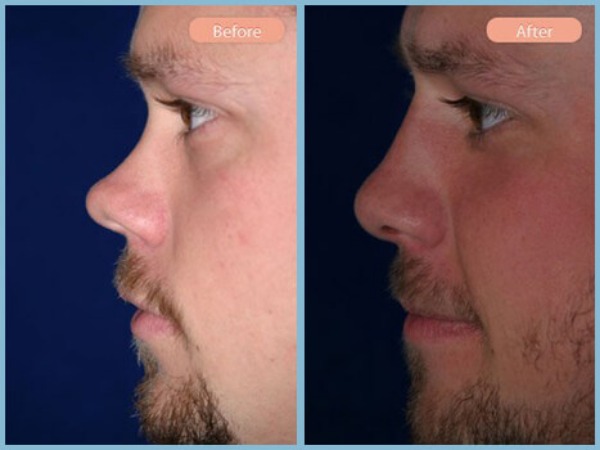 Before and After Image: Rhinoplasty - left-side